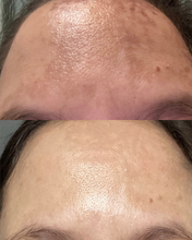 Load image into Gallery viewer, Fraxel - Buy One, Get One 50% Off