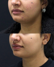 Load image into Gallery viewer, Microneedling - Buy 3 Get 1 FREE
