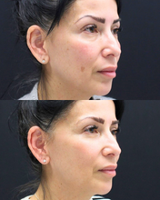 Load image into Gallery viewer, Pico Laser - Buy 3 Get 1 Free
