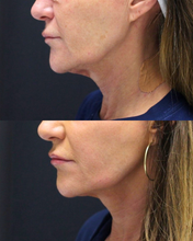 Load image into Gallery viewer, Ultherapy Lower Face - Save $500

