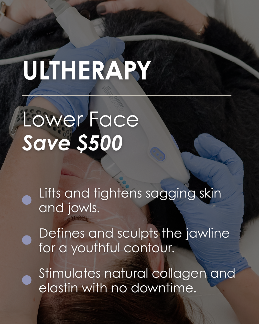 Ultherapy Lower Face - Save $500