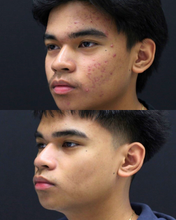 Load image into Gallery viewer, HydraFacial - Buy 2, Get 1 FREE
