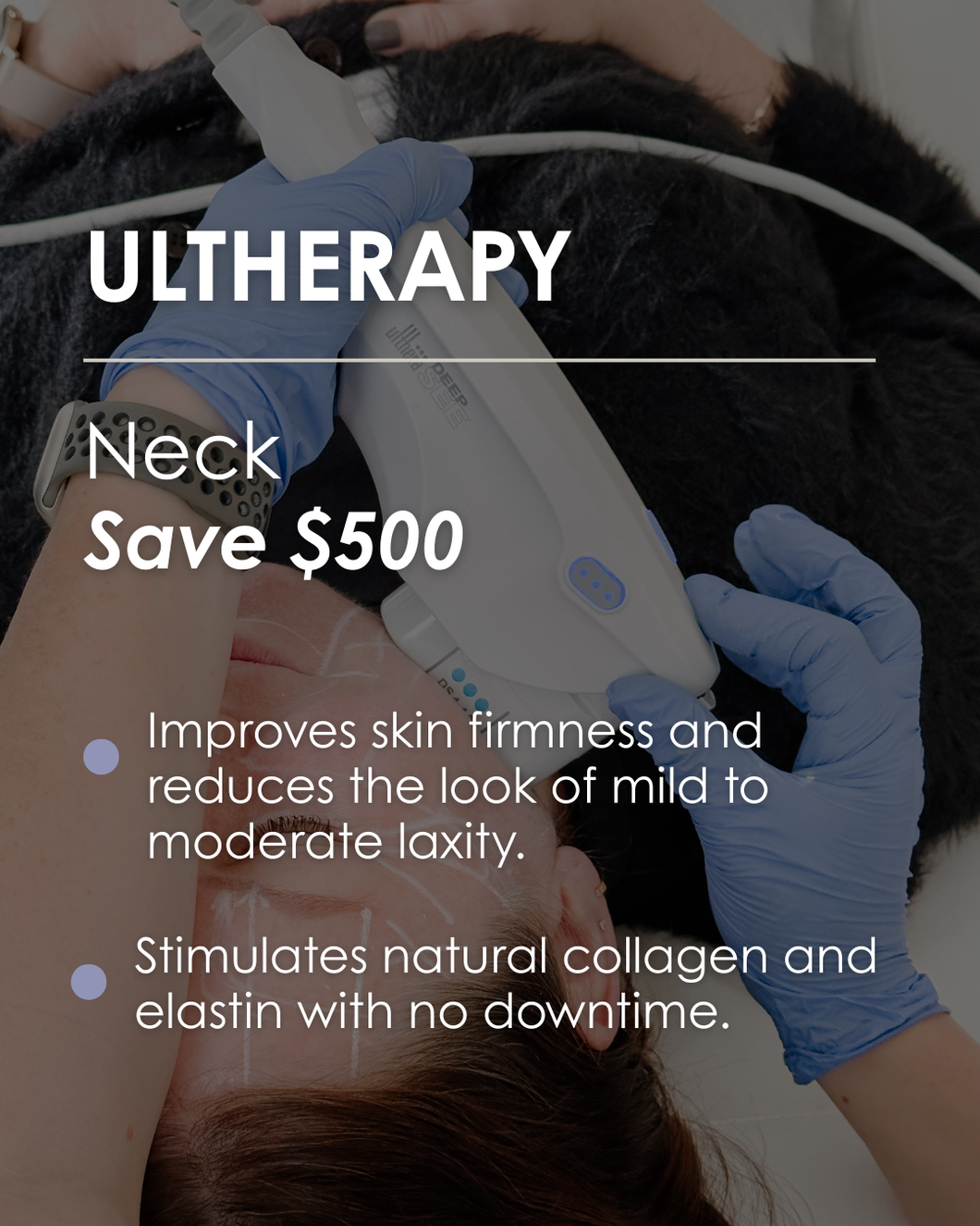 Ultherapy Neck - Save $500